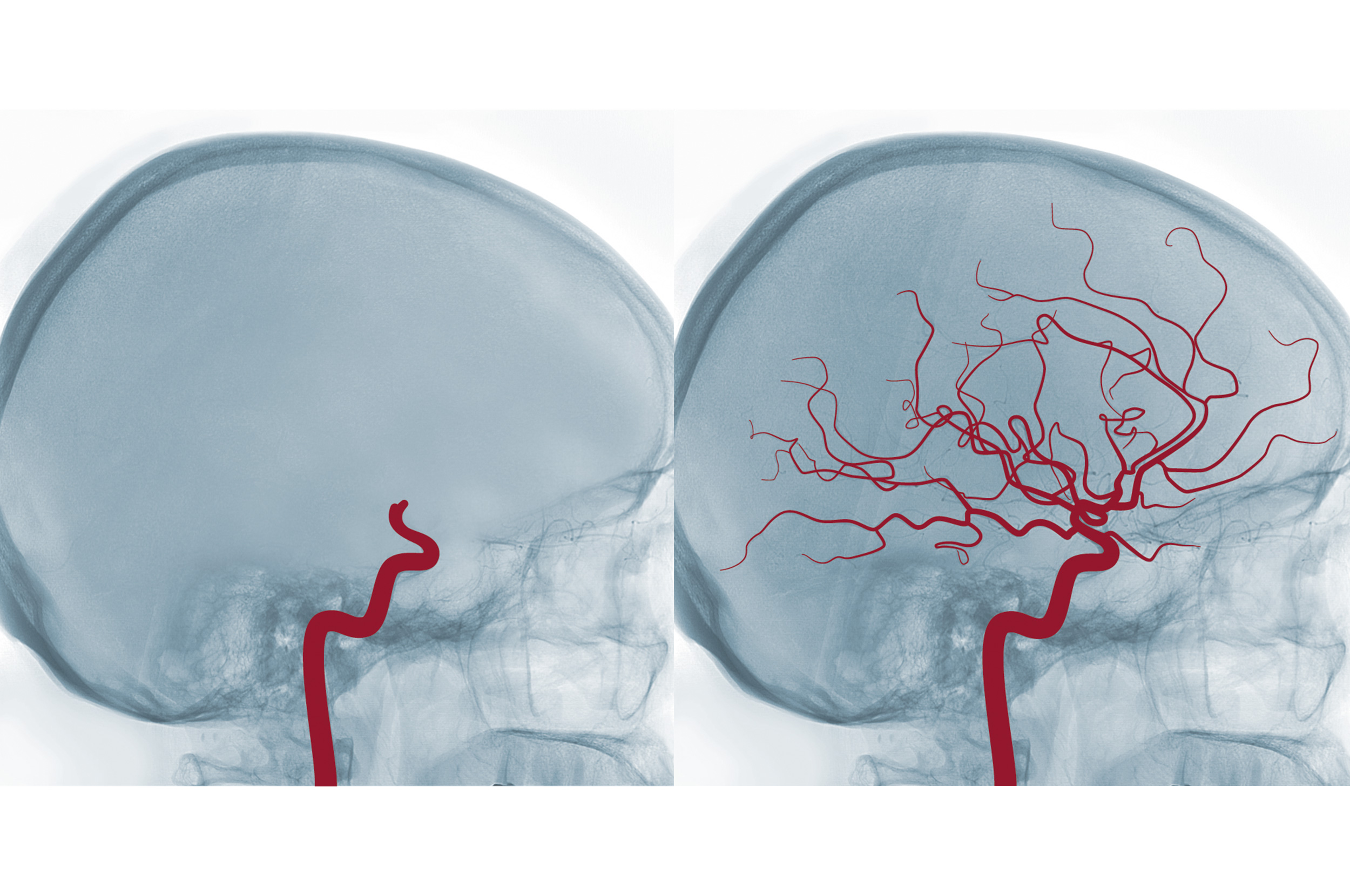 Welche Ursachen Führen Zum Hirntod www.organspende-info.de