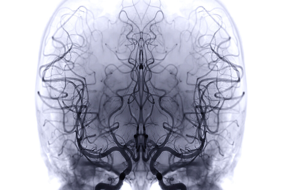 Das Foto zeigt die schwarz-weiß MRT-Aufnahme eines Gehirns.