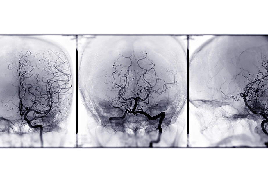 Die Abbildung zeigt drei MRT-Aufnahmen eines Gehirns nebeneinander, die alle einen anderen Blickwinkel zeigen.